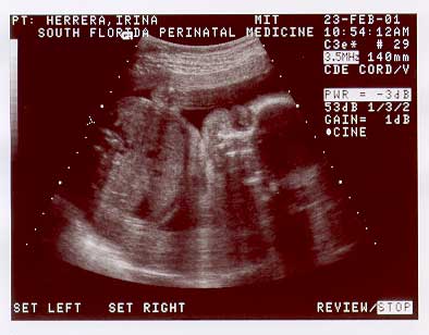 BABY-2-25WK-2.jpg (19627 bytes)