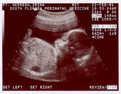 BABY-2-25WK-3.jpg (20112 bytes)